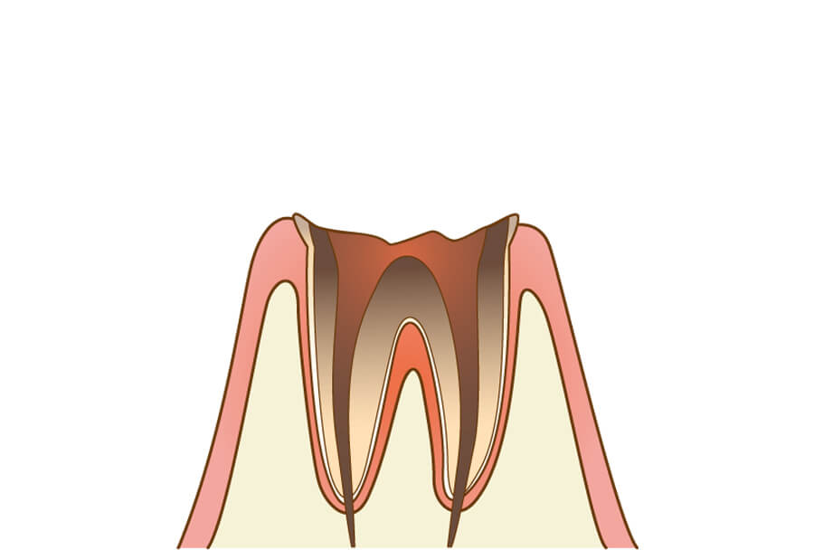 C4：歯質が失われた虫歯